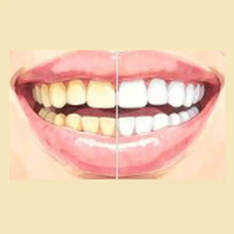 Clareamento dental profissional realizado em consultório
