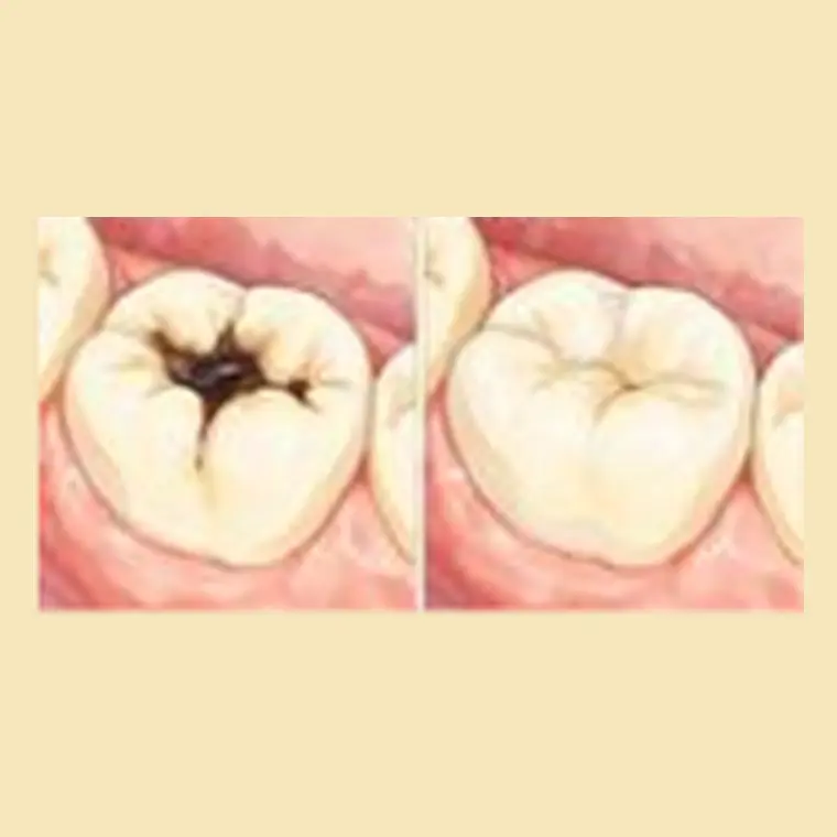 Restauração estética sendo realizada em dente posterior